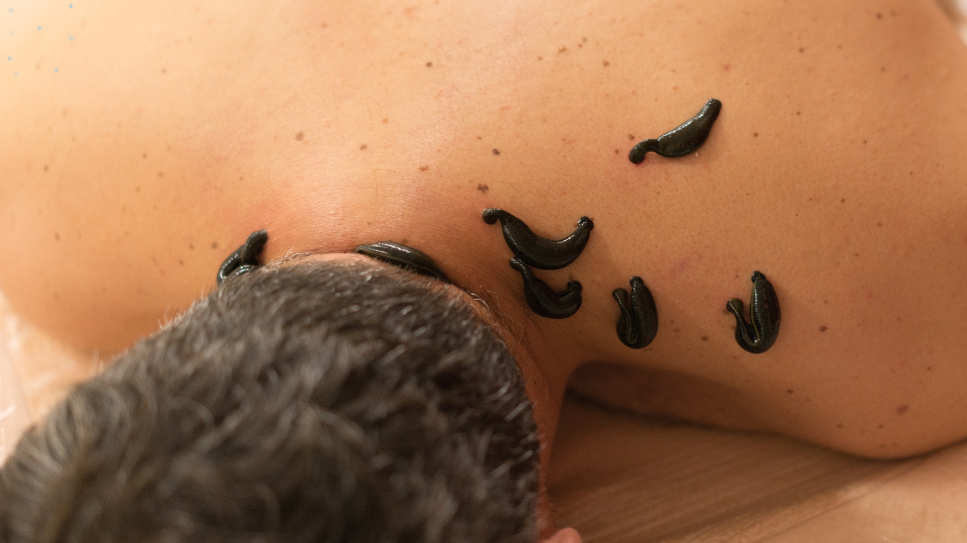 Leech Therapy in Ayurveda
