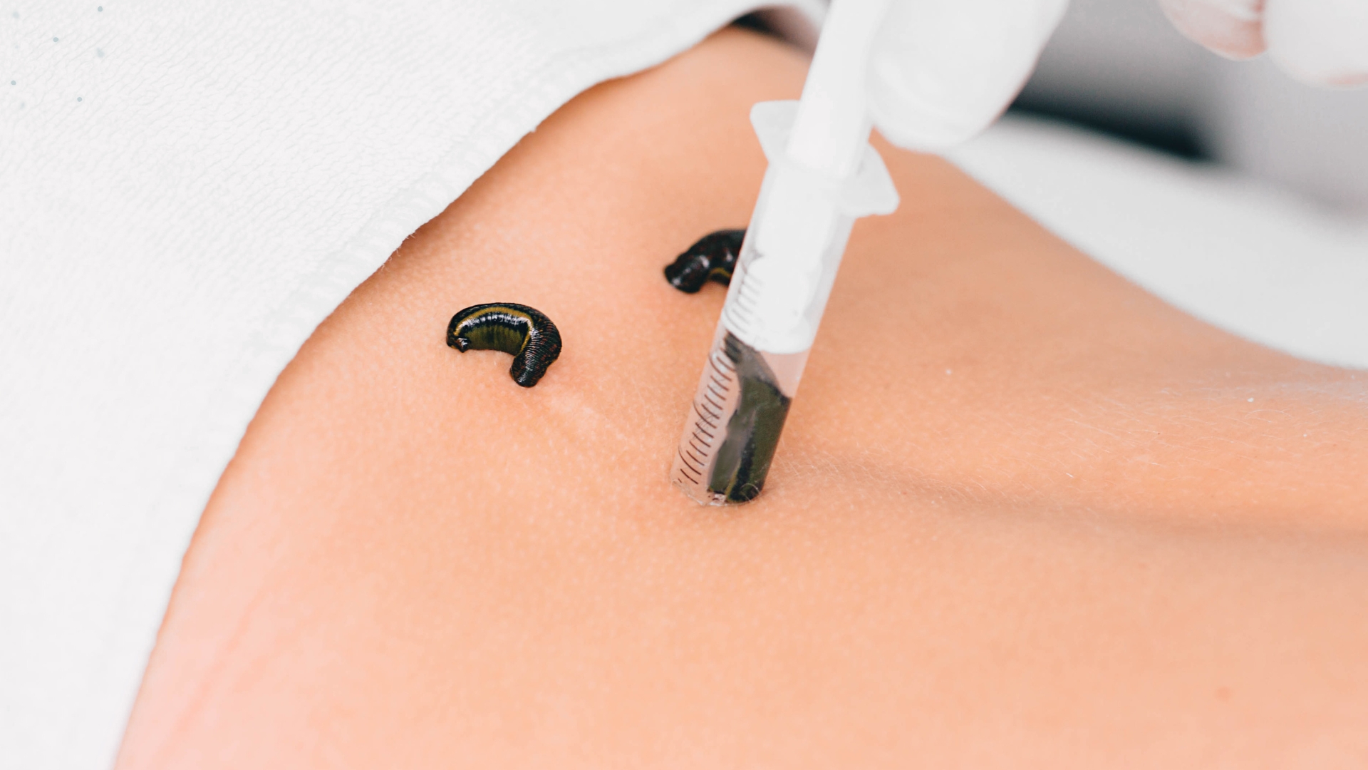 Leech Therapy for Blood Cleansing